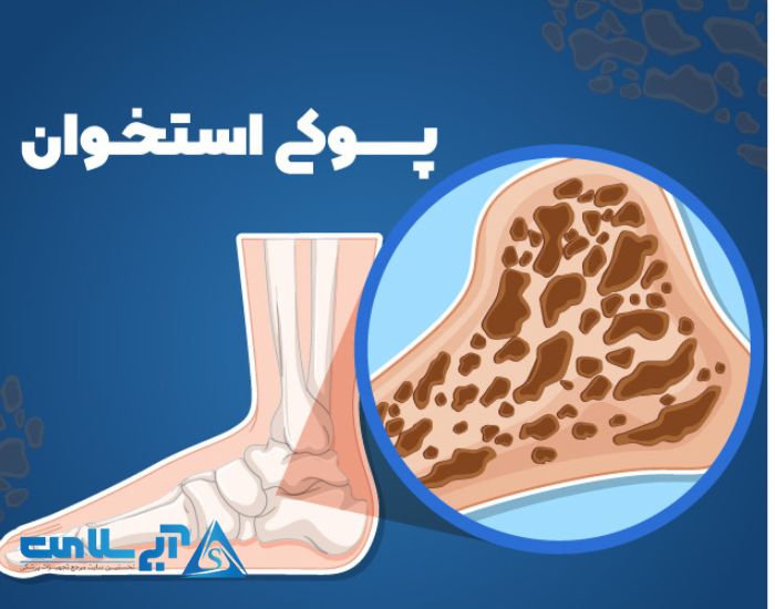 علائم پوکی استخوان