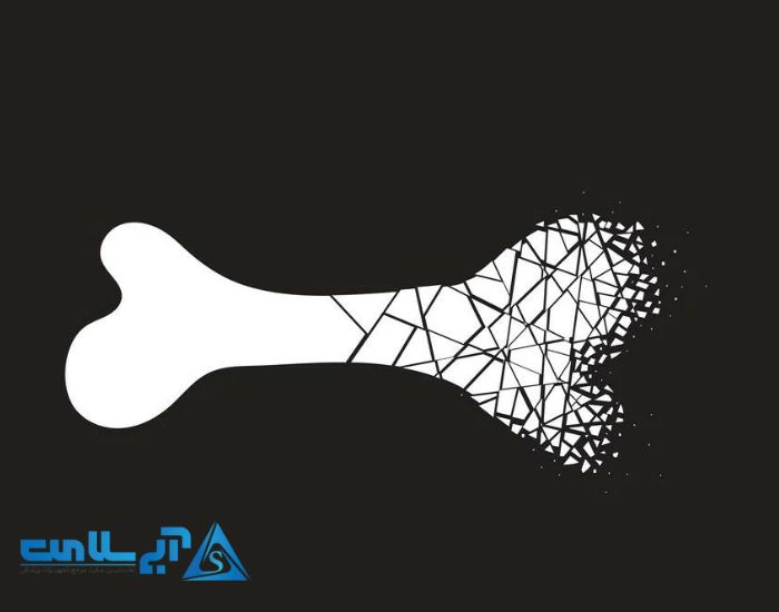 تشخیص پوکی استخوان