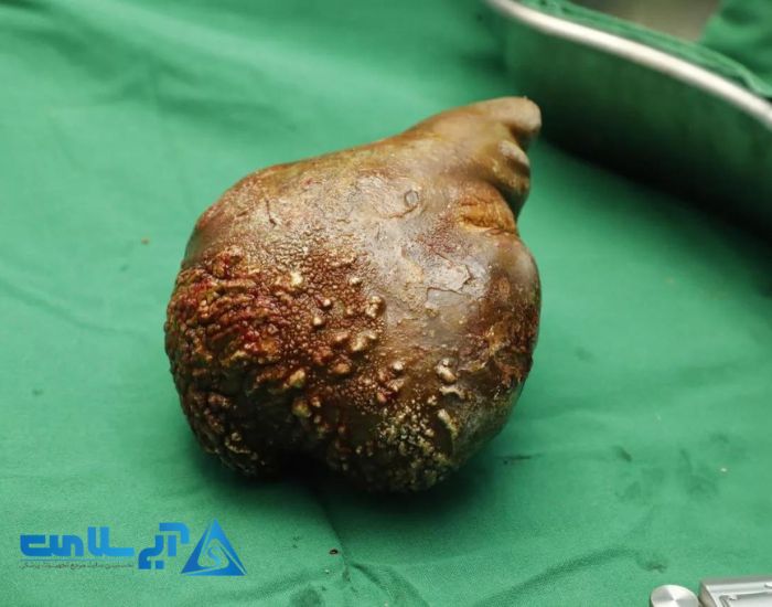 نوشیدنی برای سنگ کلیه