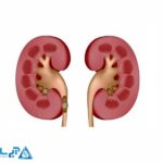 سنگ کلیه چیست + علائم و راه های دفع سنگ کلیه