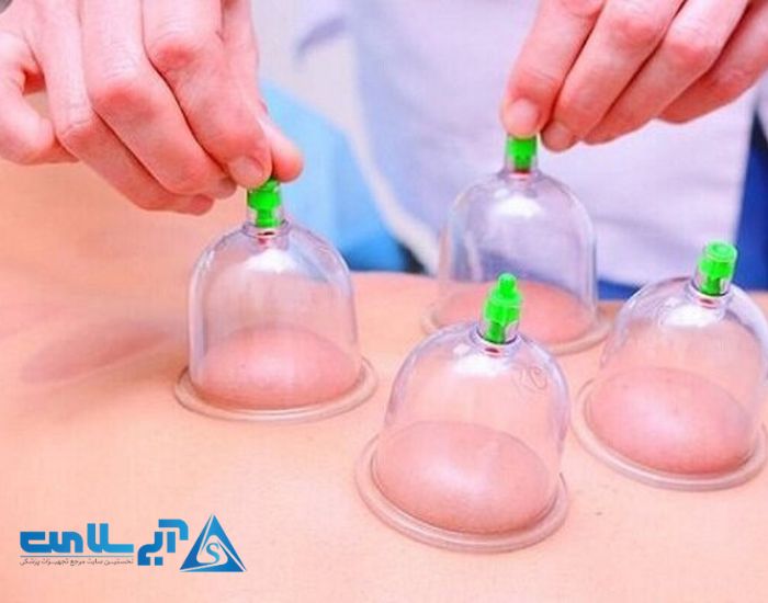 حجامت با استفاده از بادکش