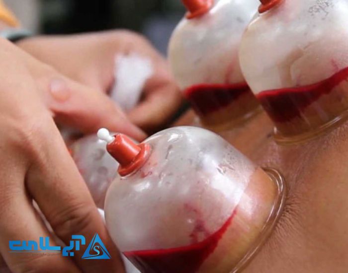 طریقه کار بادکش وکیومی
